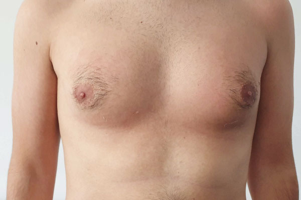 Caso de lifting facial antes