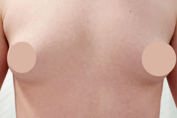 Caso de lifting facial antes