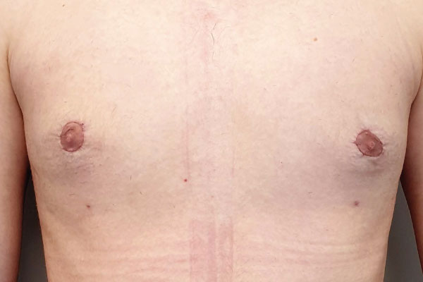 Caso de lifting facial depois