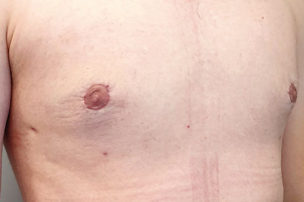 Caso de lifting facial depois