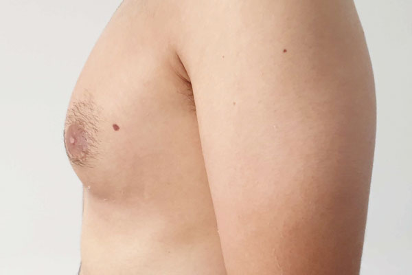 Caso de lifting facial antes