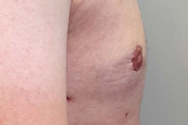 Caso de lifting facial depois