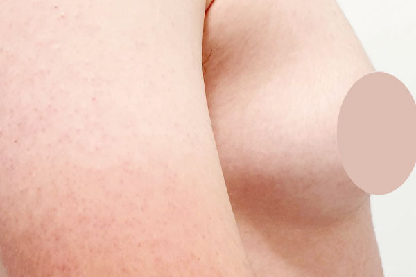 Caso de lifting facial antes