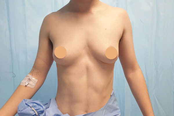 Caso de lifting facial antes