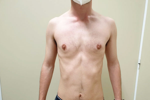 Caso de lifting facial depois