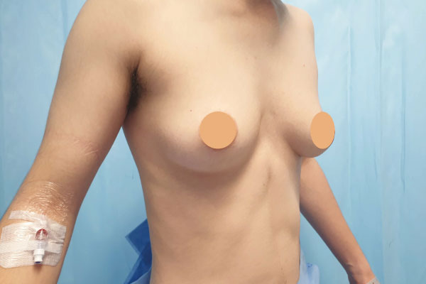 Caso de lifting facial antes