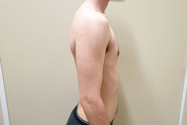 Caso de lifting facial depois