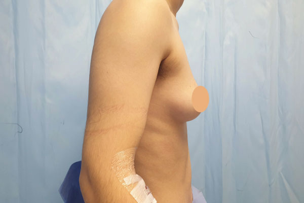 Caso de lifting facial antes