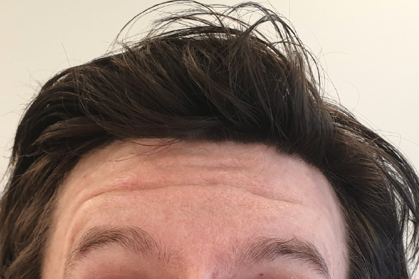 Caso de lifting facial antes