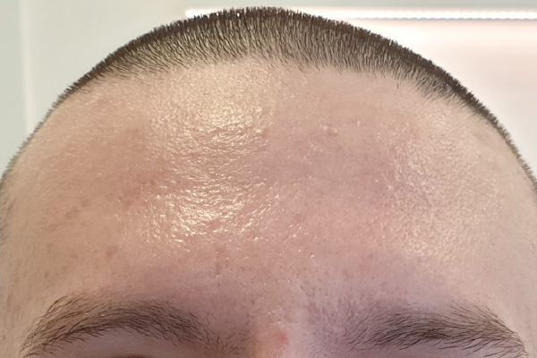 Caso de lifting facial depois